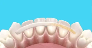 6 Cara Mengatasi Gigi Goyang agar Kuat Lagi