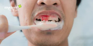 kesalahanan-umum-saat-menyikat-gigi