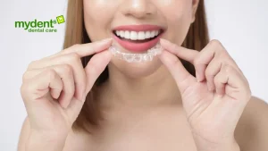 aligner-gigi-adalah